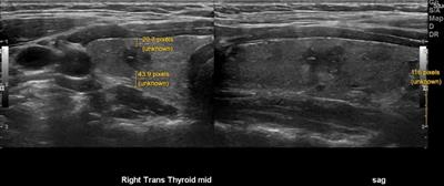 Prognostication of papillary thyroid microcarcinoma based on preoperative ultrasound